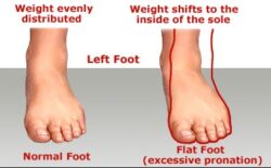 Flat Feet 1